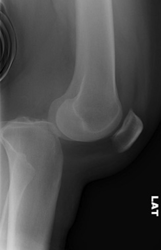 Knee dislocation posterior